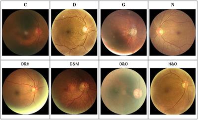 Multi-label classification of retinal disease via a novel vision transformer model